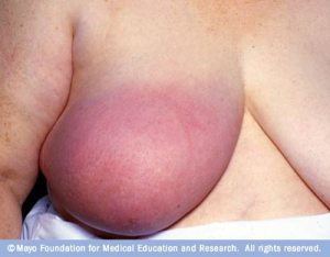 Breast Cancer