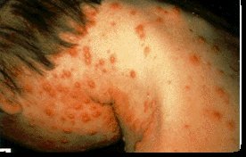 Chickenpox