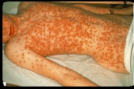 Chickenpox