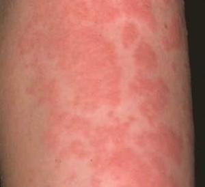 Cholinergic Urticaria