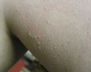 Cold Urticaria