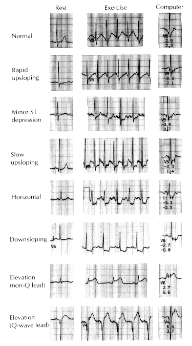 Stress ECG