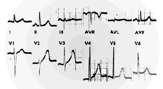 Normal ECG