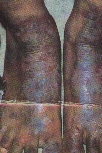 Foot Wear Dermatitis