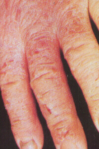 Hand Eczema