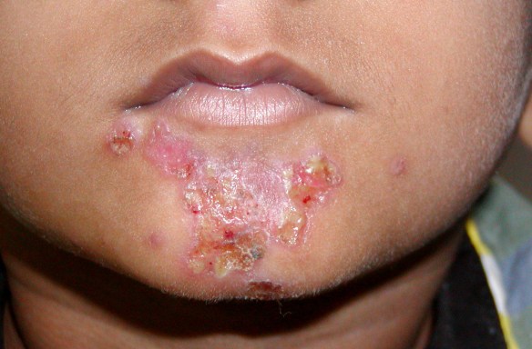 Impetigo