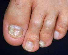 Onychomycosis