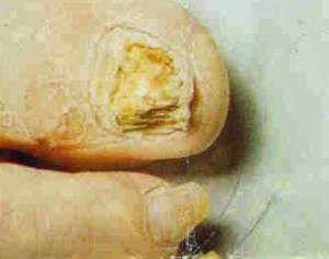 Onychomycosis