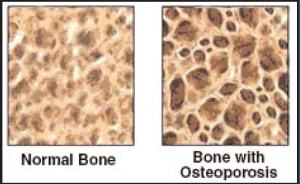 Osteoporosis Bone Density