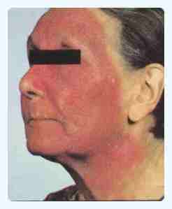PhotoContact Dermatitis