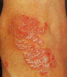 Psoriasis