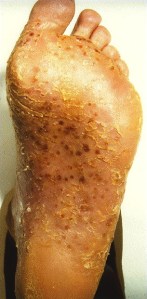 Psoriasis