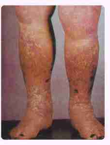 Stasis Eczema