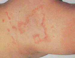 Urticaria