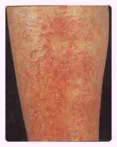 Xerotic Eczema (Dry Skin)