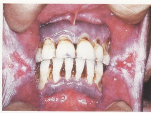 It is a white patchy lesion. Tobacco use is main cause of leukoplakia.